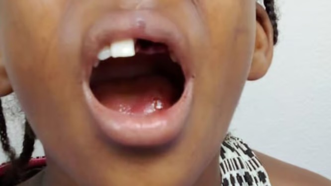 Nina-qie-perdio-dientes-en-San-Cristobal-2